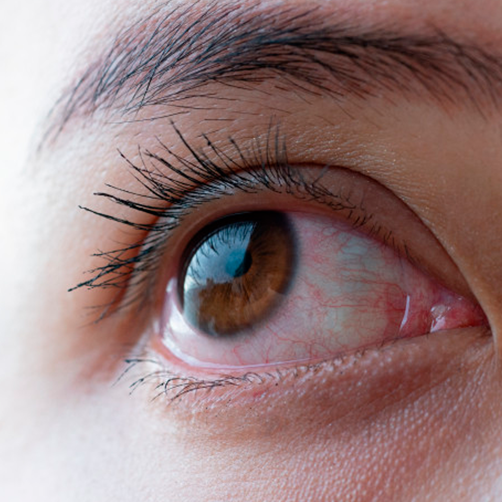 ¿Que es el Glaucoma?